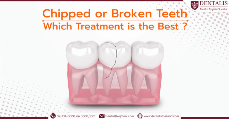 Chipped or Broken Teeth: Which Treatment is the Best?