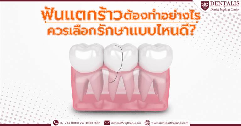 ฟันเเตกร้าวต้องทำอย่างไร ควรเลือกรักษาเเบบไหนดี ?
