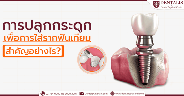 การปลูกกระดูกเพื่อการใส่รากฟันเทียม สำคัญอย่างไร