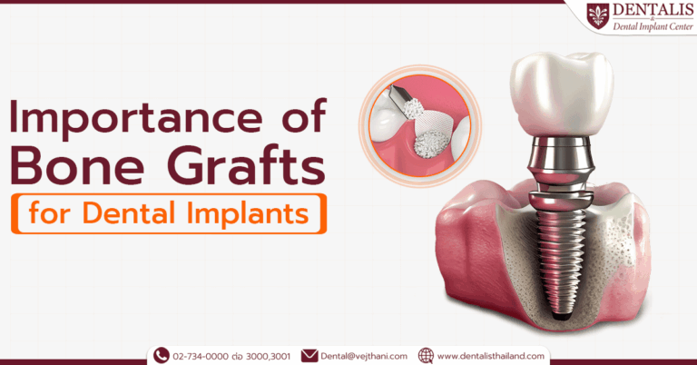 Importance of Bone Grafts for Dental Implants  