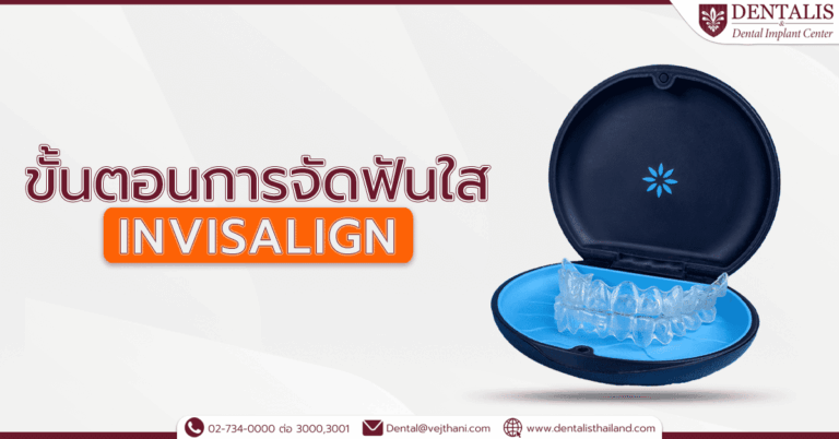 ขั้นตอนการจัดฟันใส Invisalign