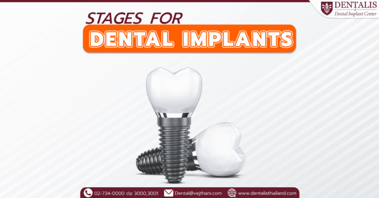 Dental Implant Process