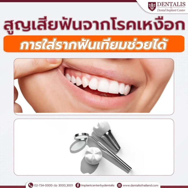 สูญเสียฟันจากโรคเหงือกการใส่รากฟันเทียมช่วยได้  