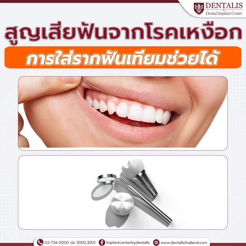 สูญเสียฟันจากโรคเหงือกการใส่รากฟันเทียมช่วยได้  