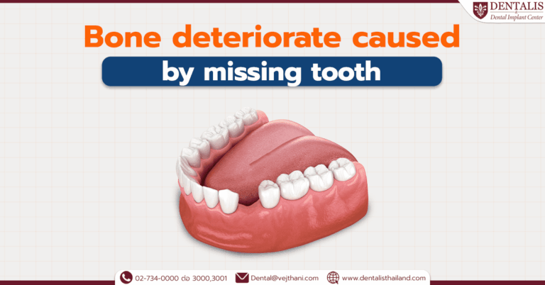 Bone deteriorate caused by missing tooth