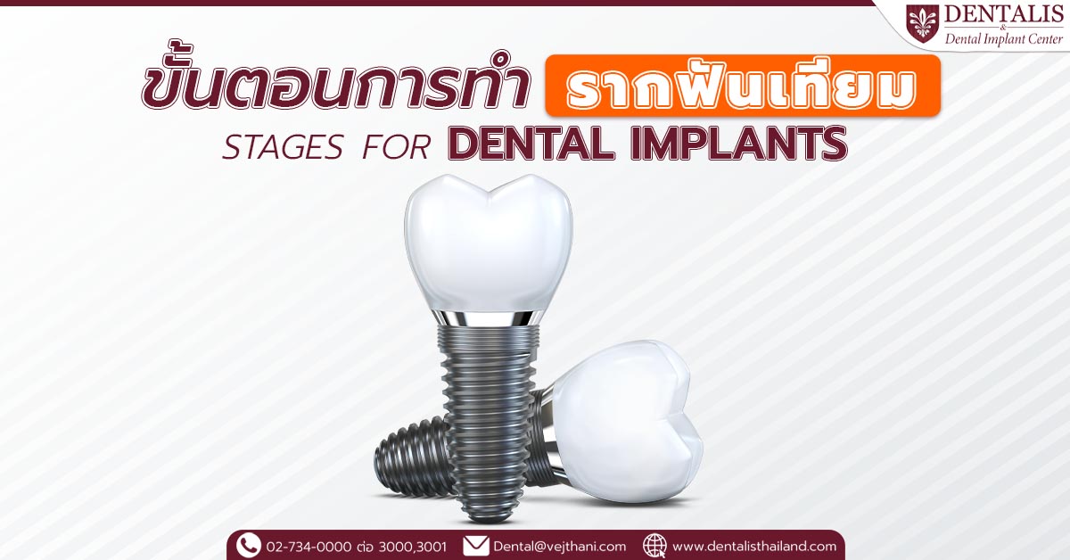 ขั้นตอนการทำรากฟันเทียม