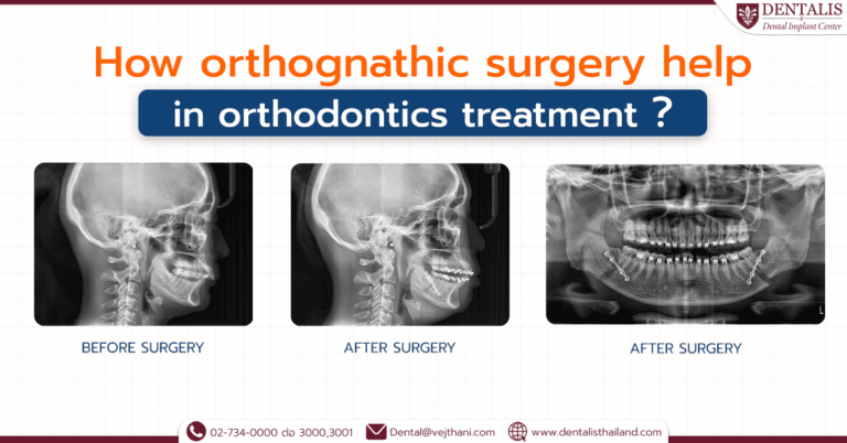 How orthognathic surgery help in orthodontics treatment?