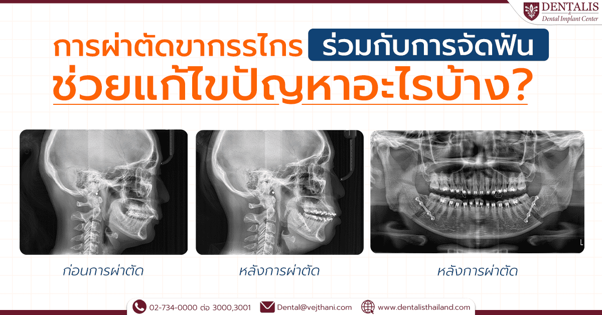 การผ่าตัดขากรรไกรร่วมกับการจัดฟัน ช่วยแก้ไขปัญหาอะไรบ้าง ?