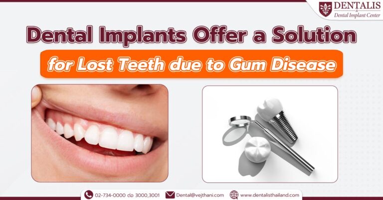 Dental Implants Offer a Solution for Lost Teeth due to Gum Disease