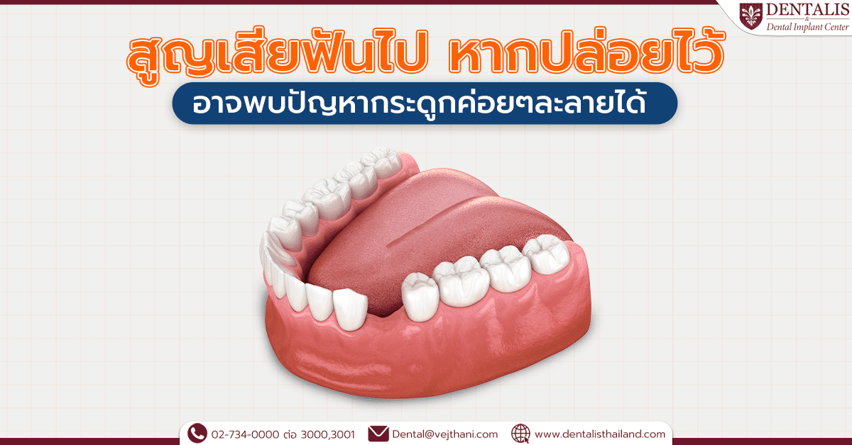 สูญเสียฟันไป หากปล่อยไว้อาจพบปัญหากระดูกค่อยๆ ละลายได้
