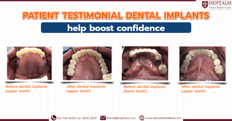 Dental Implants help boost confidence, restores oral function and improves quality of life.