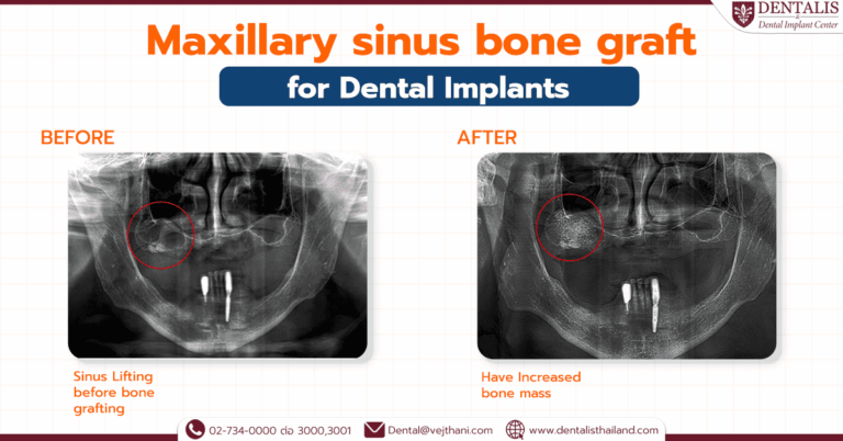 Maxillary sinus bone graft for dental Implants
