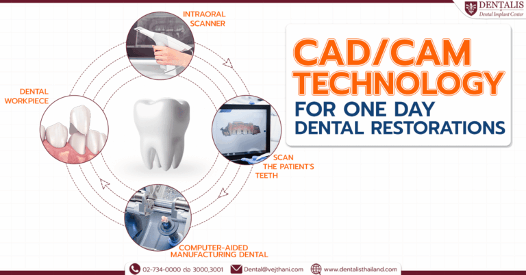 CAD/CAM เทคโนโลยีเติมฟันสวยภายใน 1 วัน