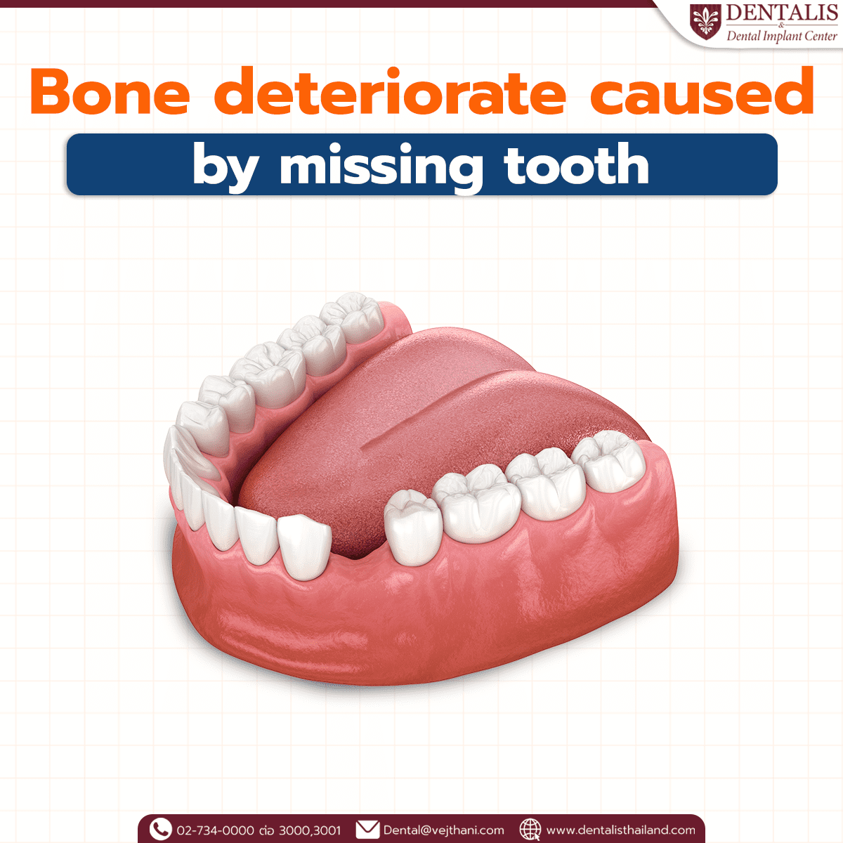 Bone deteriorate caused by missing tooth Dentalisthailand