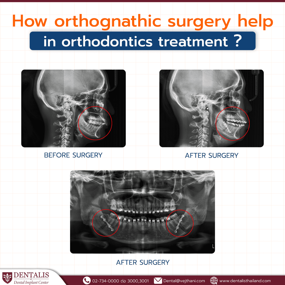 How orthognathic surgery help in orthodontics treatment? Dentalisthailand