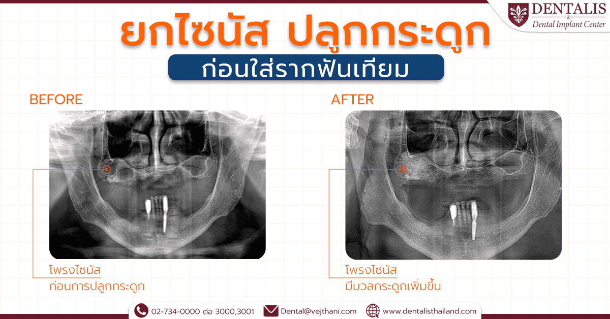 ยกไซนัส ปลูกกระดูกก่อนใส่รากฟันเทียม