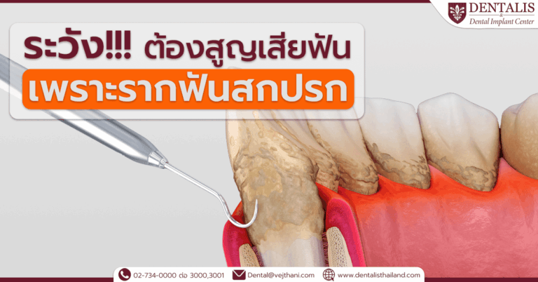 ระวัง!!! ต้องสูญเสียฟัน เพราะรากฟันสกปรก