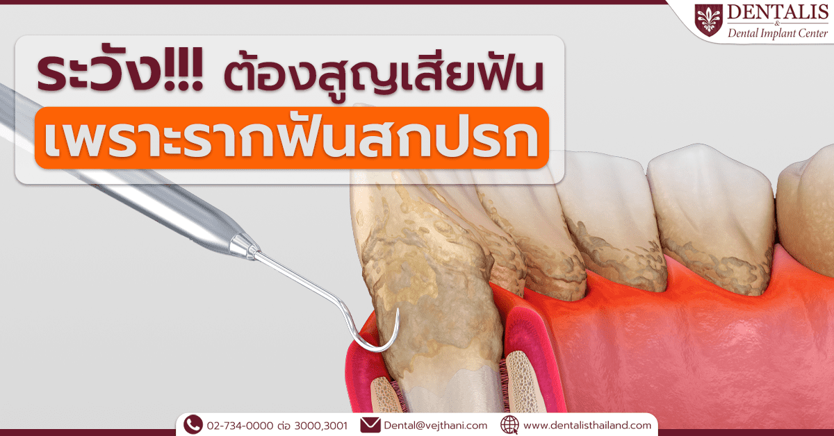ระวัง!!! ต้องสูญเสียฟัน เพราะรากฟันสกปรก