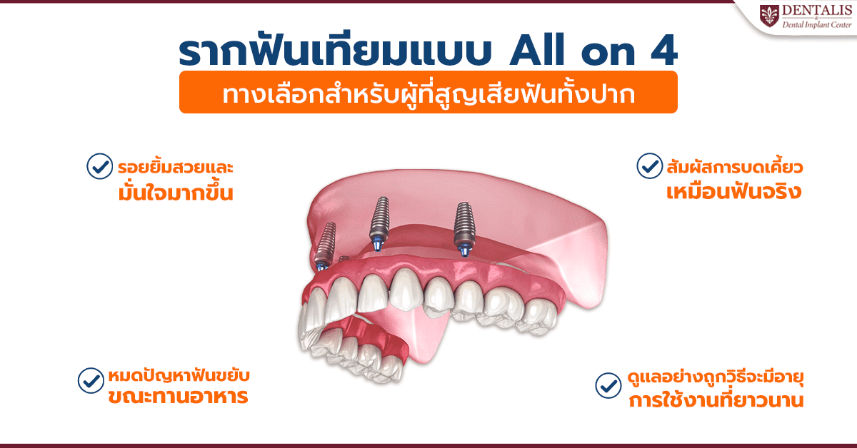 รากฟันเทียมแบบ All on 4 ทางเลือกสำหรับผู้ที่สูญเสียฟันทั้งปาก