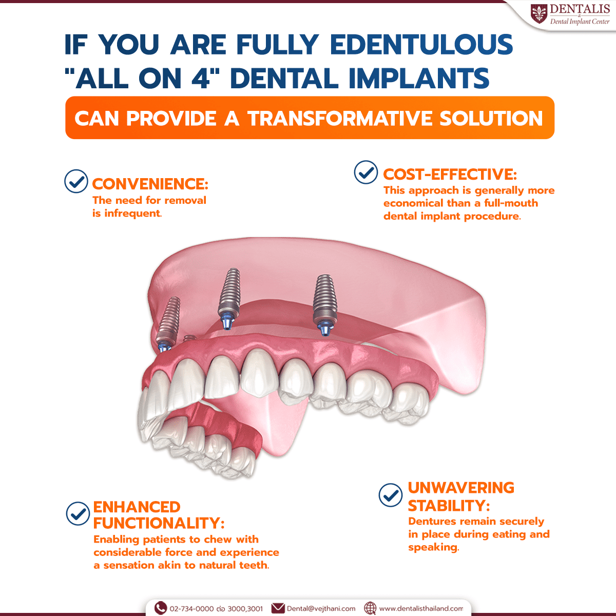 If you are fully edentulous, 'All on 4' dental implants can provide a ...