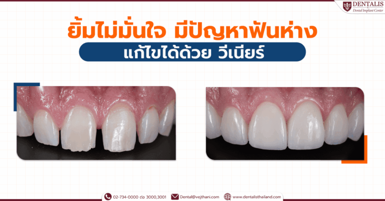 ยิ้มไม่มั่นใจ มีปัญหาฟันห่างแก้ไขได้ด้วยวีเนียร์