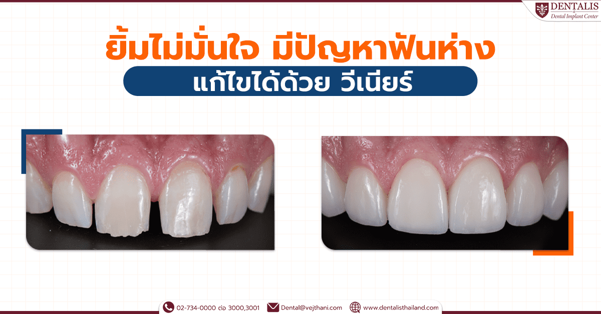 ยิ้มไม่มั่นใจ มีปัญหาฟันห่างแก้ไขได้ด้วยวีเนียร์